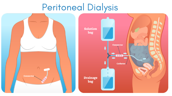 Peritoneal-dialysis